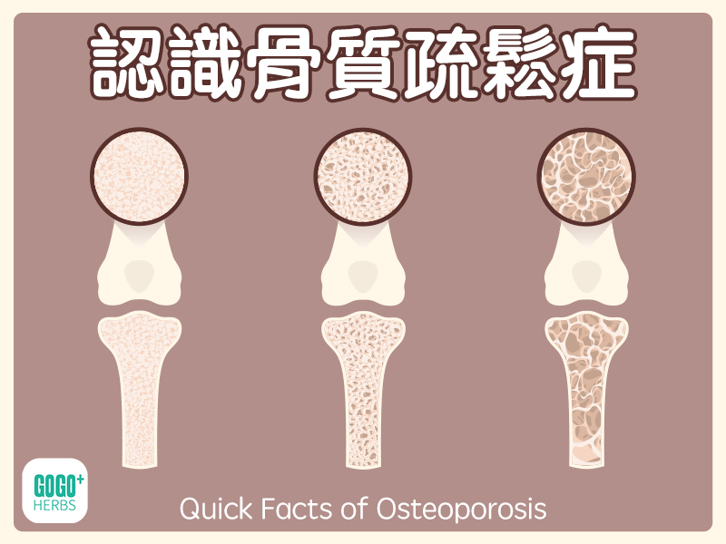認識骨質疏鬆症
